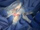 Médicos del IMSS Aguascalientes realizan cirugía a recién nacida para reintroducir intestino a cavidad abdominal